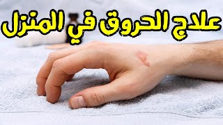 دواء علاج للحروق في المنزل ( الاسعافات الاولية للحروق بانواعها )