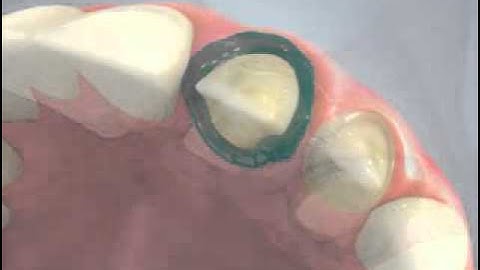 Tissue Managment Double Cord Technique Video