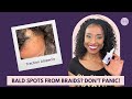 BALD SPOTS FROM BRAIDS?  DON&#39;T PANIC!