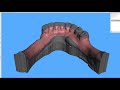 Digital Flexible Partial Dentures Using Blue Sky Plan and Meshmixer