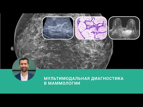 Мультимодальная диагностика в маммологии - вебинар Mammologicum