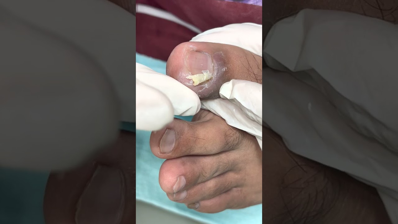 Ep_4317 Ingrown toenail removal 👣 พี่..ผมขอให้เอาออกภายใน 3 วิ ครับ 😁