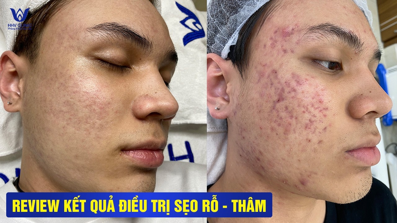 SẸO RỖ ĐẦY ĐẾN 60% CHỈ SAU 1 BUỔI – LẤY LẠI DIỆN MẠO ĐIỂN TRAI