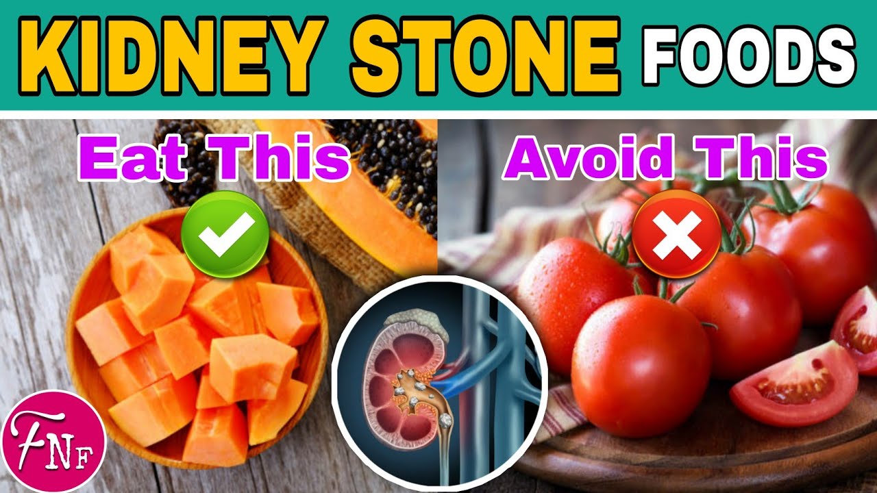  Kidney Stone Diet  17 Foods to Eat and 14 Foods to Avoid