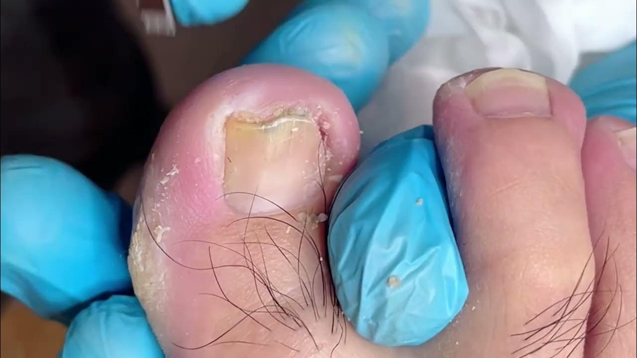 How to repair ingrown toenail YouTube