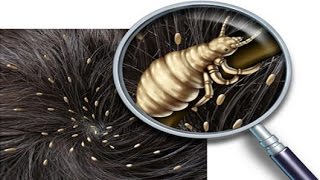 Skolstart För Både Barn Och Löss Så Blir Du Lusfri Naturligt