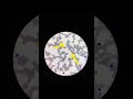 Malaria Positive Slides, ম্যালেরিয়া পসিটিভ, Microscopic views of Malaria.