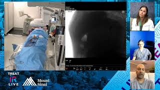 Y90 Radioembolization with Glass Microspheres for Infiltrative Hepatocellular Carcinoma (HCC)