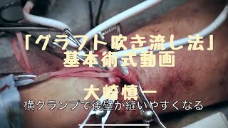 ”グラフト吹き流し法”  基本術式ビデオ .The surgical techniques of FUKINAGASHI (Graft Drifting Technique )VA過剰血流治療