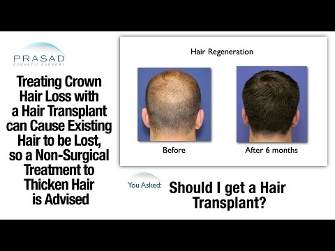 Male Pattern Baldness at the Crown can be Treated without a Risky Hair Transplant