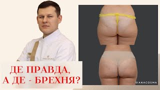 ЛІПОФІЛІНГ ГРУДЕЙ ТА СІДНИЦЬ🔥 ДЕ ПРАВДА, А ДЕ БРЕХНЯ ⁉️