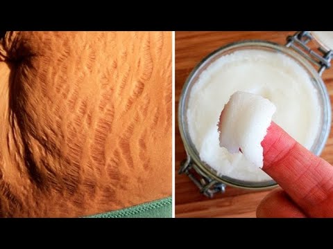 Video: 3 cách để thoát khỏi vết rạn da nhanh chóng