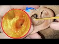 Horror: Clean dry earwax in the ear canal, infected ear canal | ASMR | EP 97