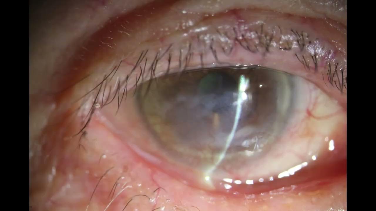 PostAMT healing of corneal ulcer, cataract surgery with corneal