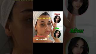 🙄 Aankhon ke neeche dark circles aakhir hote kyu hain? 🤯