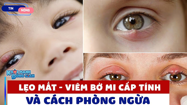 Nguyên nhân gây lẹo mắt