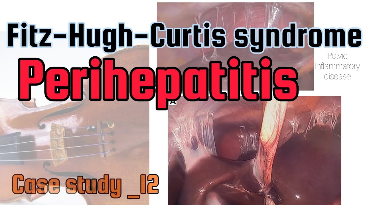 Fitz-Hugh-Curtis syndrome | Perihepatitis | case_study_12 - YouTube