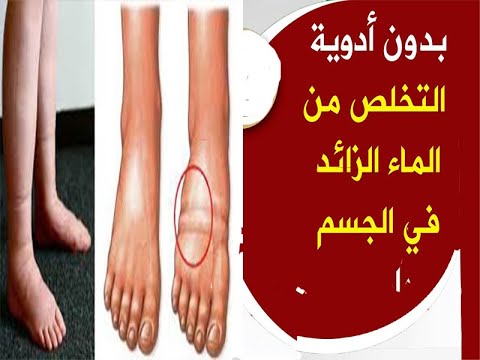 6 طرق طبيعية تخلصك من احتباس الماء بالجسم