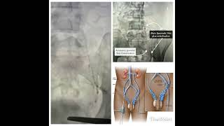 Varicocele Glue Embolization