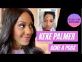 Keke Palmer Reveals Acne & Polycystic Ovarian Syndrome (PCOS). A Doctor Discusses