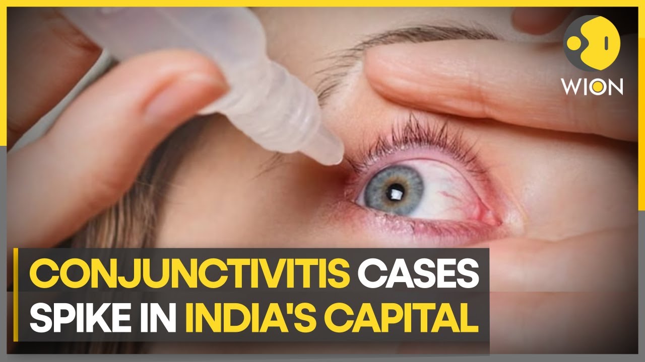 Conjunctivitis cases on rise in India, infection spread mostly in younger population | WION