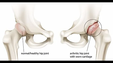 What Are My Treatment Options for Hip Arthritis? |...