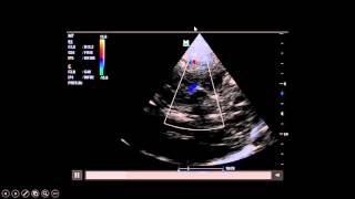 the complete story [How to do transcranial doppler step by step approach]