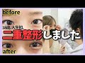【二重整形】奥二重からついに念願の二重に!!!【密着】