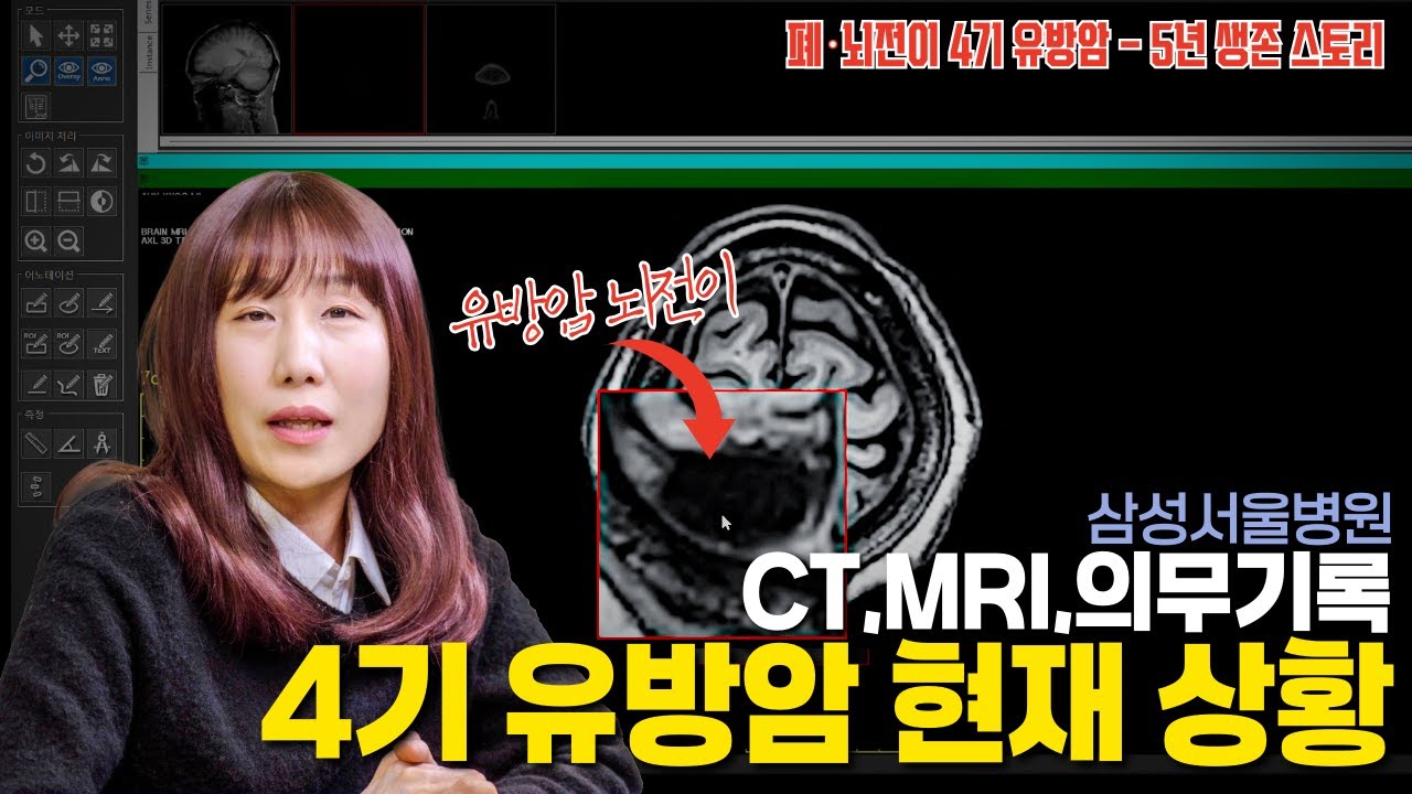 [4기 유방암] 삼성서울병원 임상 23차 진행 확인 | CT,MRI,의무기록 같이 보시죠 #유방암 #삼성서울병원 #항암