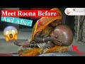 Weird Diseases: Incredible Transformation of Roona! 😱 ~Body Bizarre!