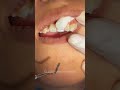 Antes y después eliminación de caries en los dientes💥 #shortvideo #caries