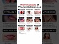 Vitamin Deficiency Warning Signs | Symptoms of Vitamins A, B, C, D, E &amp; K | Health Tips