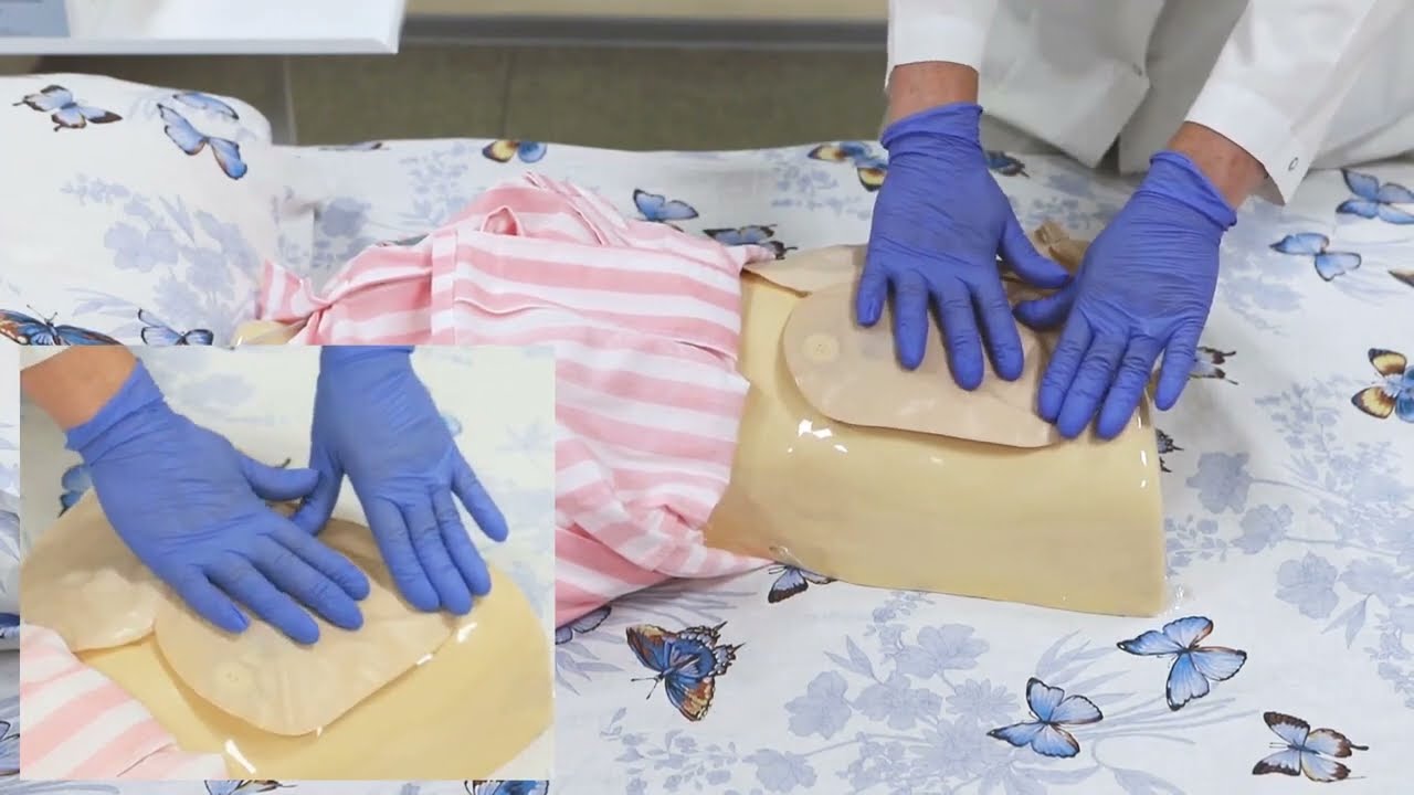 Уход за колостомой