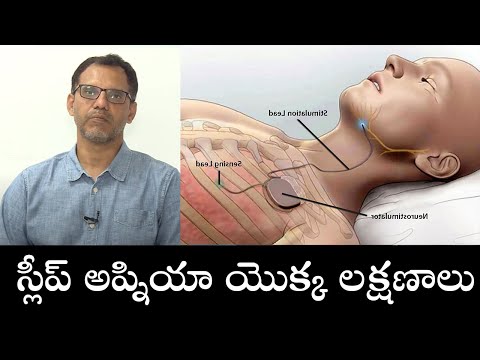 Symptoms of Sleep Apnea | స్లీప్ అప్నియా యొక్క లక్షణాలు | Samayam Telugu