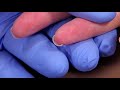 Perform a capillary puncture obtain a blood sample by capillary puncture