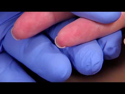 Perform a Capillary Puncture Obtain a Blood Sample by Capillary Puncture