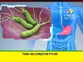 ¿Qué es la helicobacter pylori y cuáles son sus síntomas?