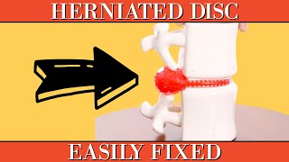 Herniated Disc Clearly Explained & Easily Fixed