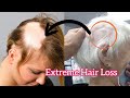 Extreme har loss etm 66 haircut hairloss hairstyle shorthaircut kuaforlevent haircut