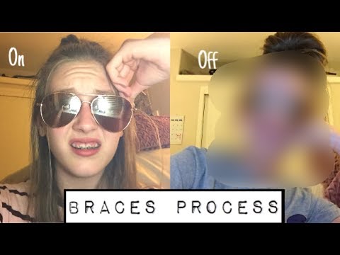 Everything you need to know with braces! |On and off experience!|