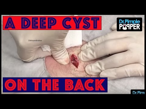 Got To Go DEEP With THIS Cyst On The Back