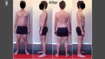 Rolfing 10 Series Before & After