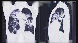 How lung cancer screenings could save your life