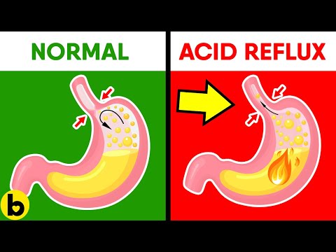 Video: Är Baking Soda Svaret På Acid Reflux?