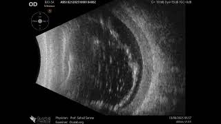 20 MHz Annular Ophthalmic Ultrasound ABSolu, Total retinal detachment, marked choroidal edema , 3665