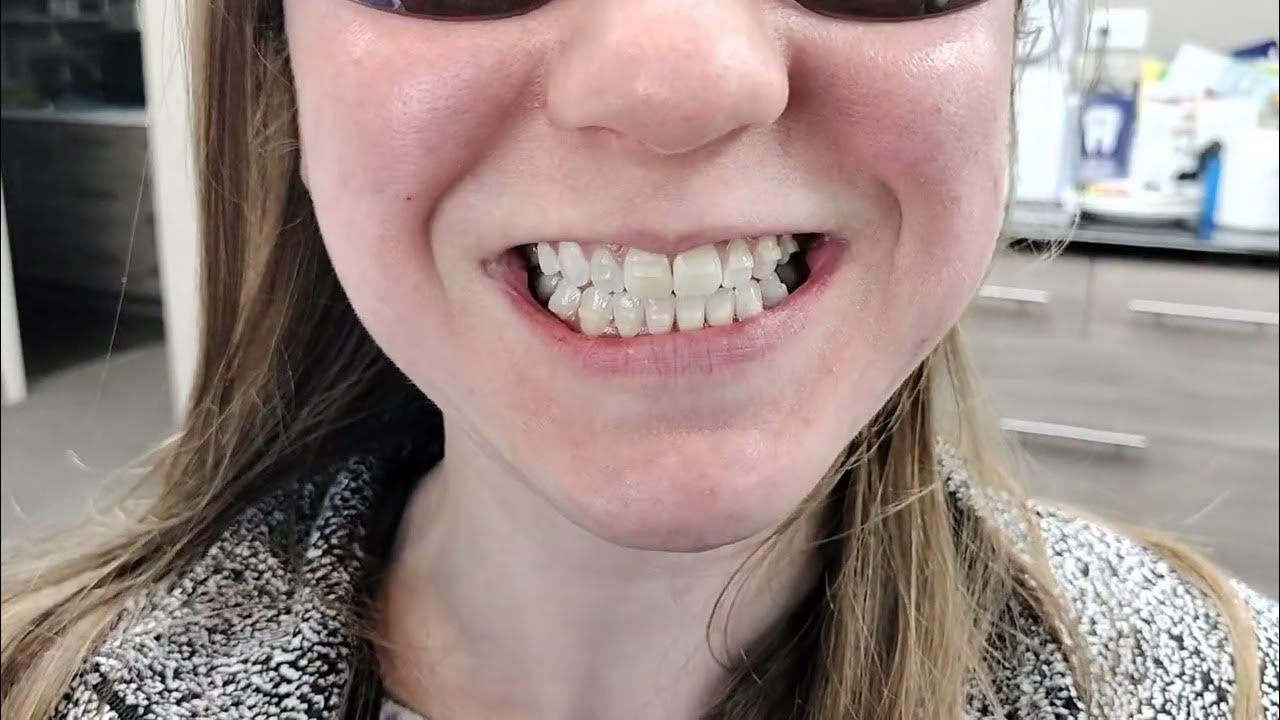 SureSmile Clear Aligners with rubber bands to correct the bite and
