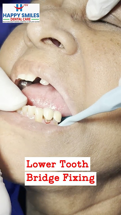 Lower Tooth Bridge Fixing || Happy Smiles Dental Clinic