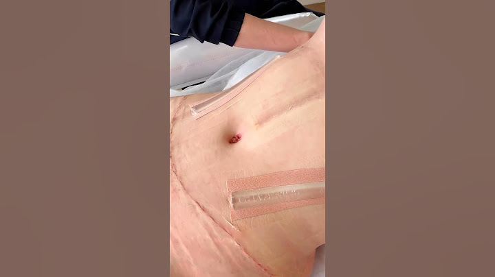 Cirurgia Plástica: a cicatriz da Abdominoplastia fica invisível?
