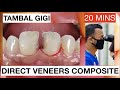 Step by step direct veneers composite anterior multiple cases 20mins  general dentist griya rr