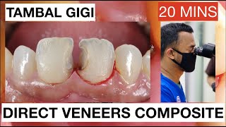 Step by Step Direct Veneers Composite Anterior Multiple Cases 20mins | General Dentist Griya RR